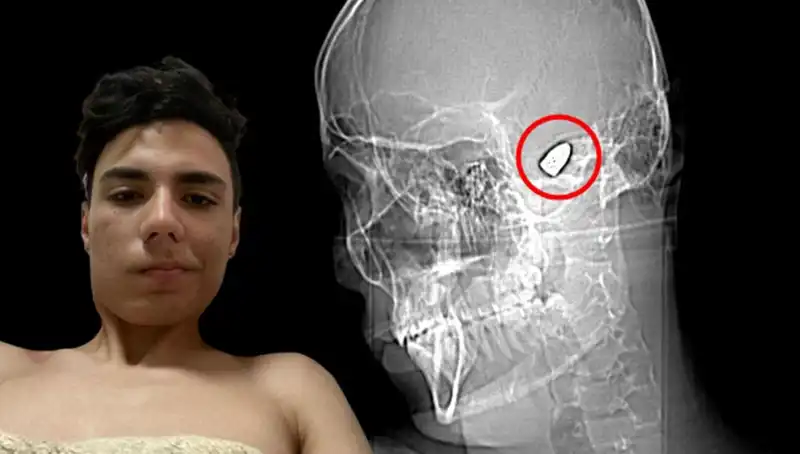 Hayatını Kafasında Taşıdığı Bomba ile Şekillendiren Genç: Dram Dolu Hikaye